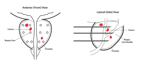 Prostate-Biopsy-Graphic016-1024x475